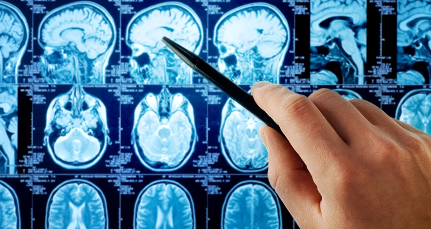 頭痛與腦瘤關聯