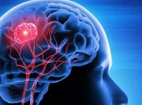 腦癌末期治療