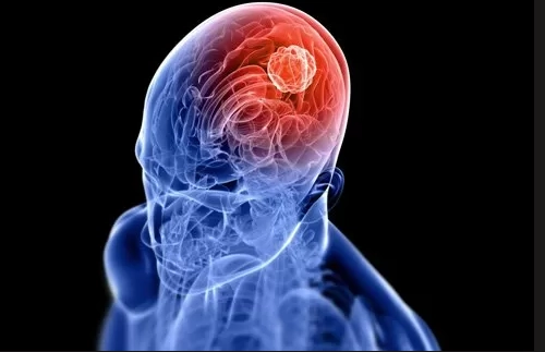 腦癌末期治療