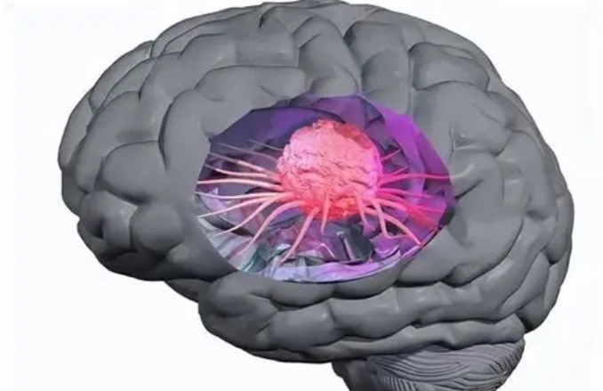 良性腦瘤預後 良性腦瘤預後