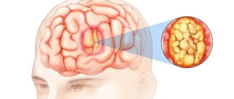 良性腦瘤生存期 良性腦瘤生存期