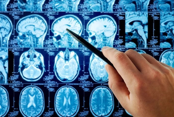 惡性腦瘤治療 惡性腦瘤治療