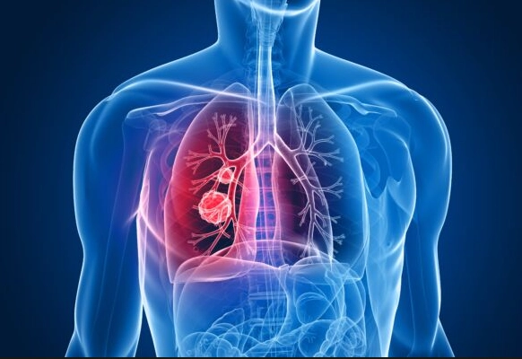 癌症早期症狀 癌症早期症狀