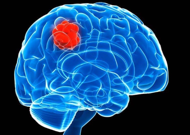 腦瘤治療選項 腦瘤治療選項