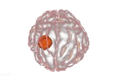 良性腦瘤生存期 良性腦瘤生存期