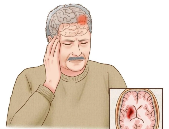 腦瘤治療選項 腦瘤治療選項