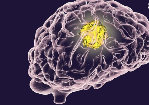 腦癌末期治療