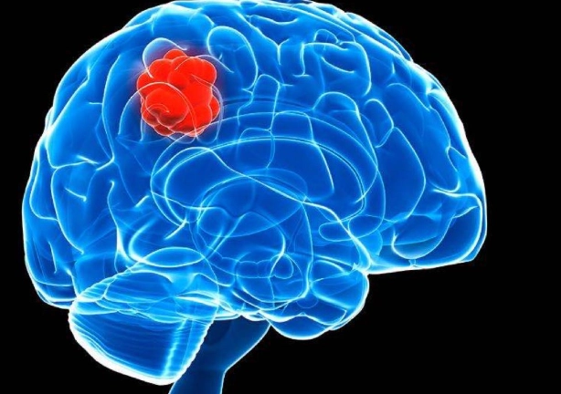 惡性腦瘤存活率 惡性腦瘤存活率
