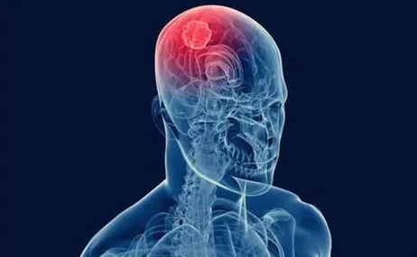 惡性腦瘤存活率 惡性腦瘤存活率