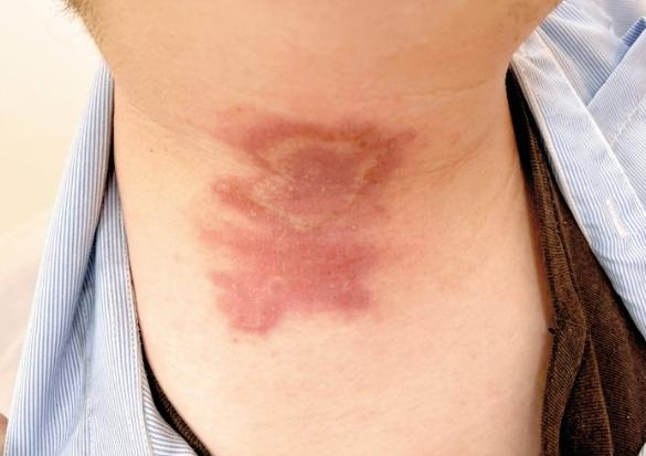 傷口自癒 傷口自癒