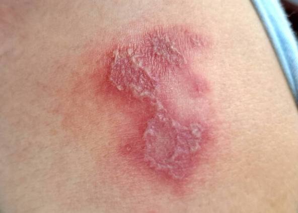 隱翅蟲處理 隱翅蟲處理