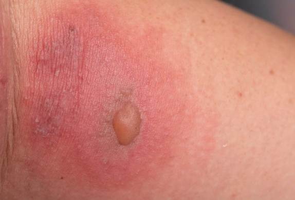 隱翅蟲傷口 隱翅蟲傷口