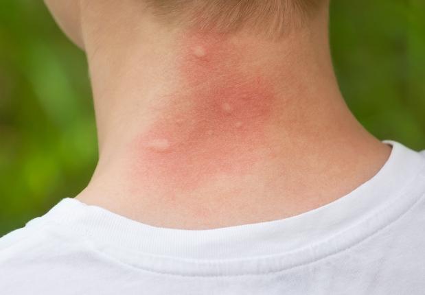 蟲咬止癢 蟲咬止癢