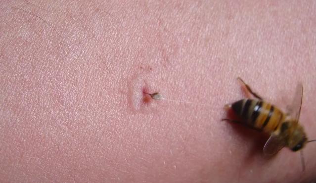 蟲咬藥膏 蟲咬藥膏