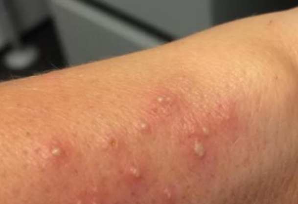 蟲咬藥膏 蟲咬藥膏