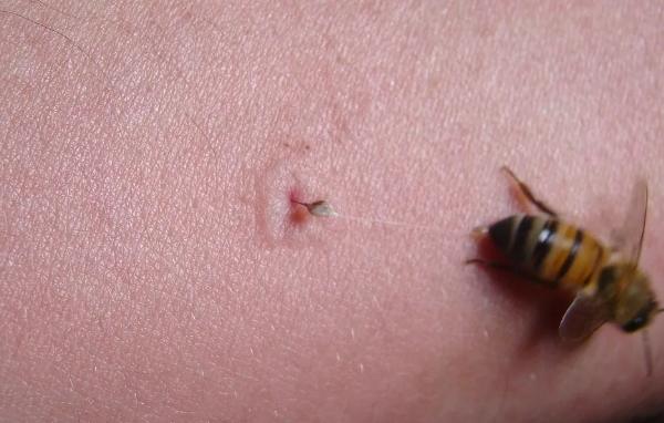 蟲咬症狀處理 蟲咬症狀處理