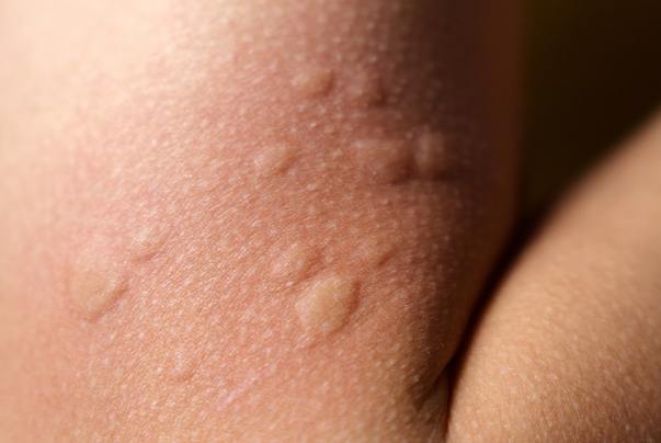 被蟲咬看什麼科 被蟲咬看什麼科