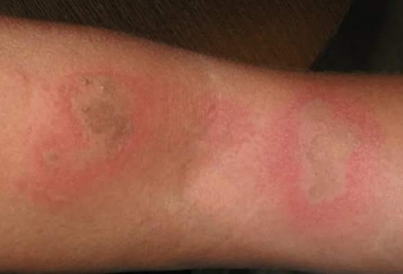 隱翅蟲皮膚炎 隱翅蟲皮膚炎