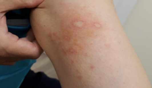 隱翅蟲藥膏 隱翅蟲藥膏