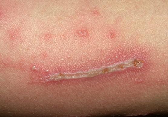 隱翅蟲皮膚炎 隱翅蟲皮膚炎