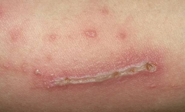 隱翅蟲傷口 隱翅蟲傷口