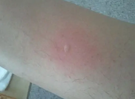 被咬腫很大硬硬的