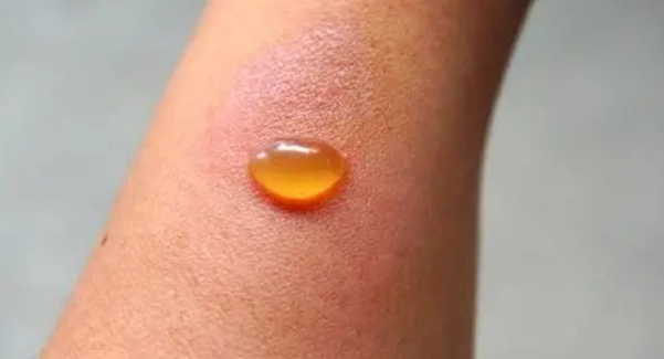 蟲咬藥膏推薦 蟲咬藥膏推薦