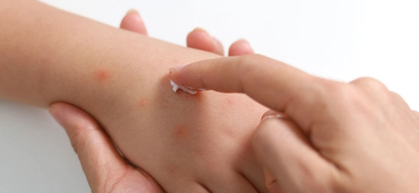 蟲咬處理 蟲咬處理