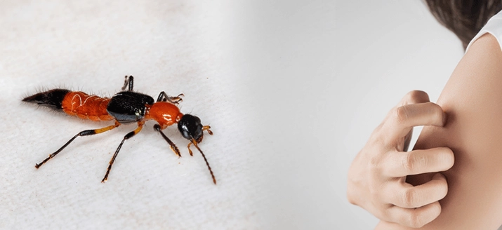 蟲咬水泡處理 蟲咬水泡處理