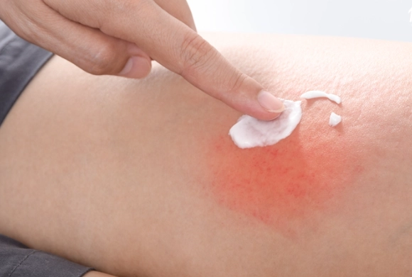 蟲咬紅腫硬塊 蟲咬紅腫硬塊