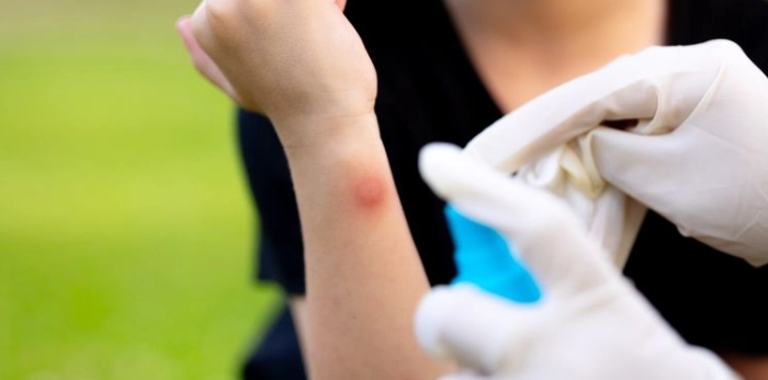 蟲咬紅腫硬塊 蟲咬紅腫硬塊