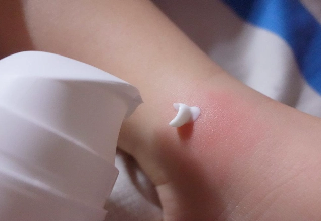 蟲咬止癢 蟲咬止癢