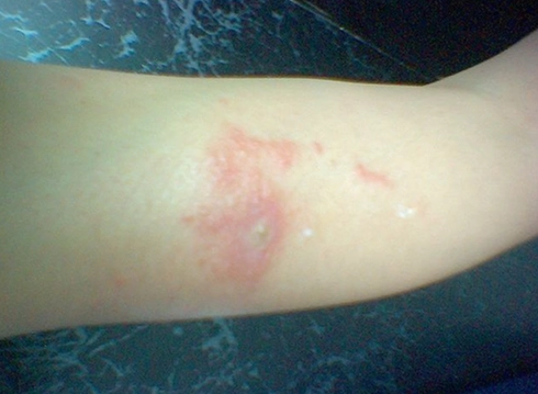 隱翅蟲處理方法