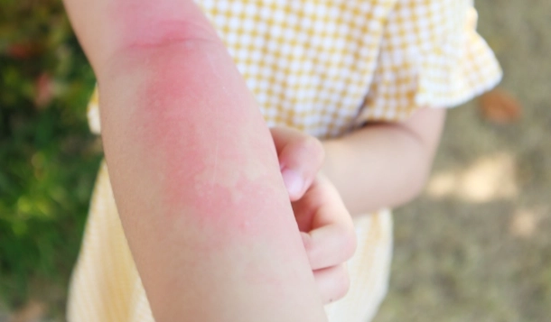 蟲咬刺痛處理 蟲咬刺痛處理
