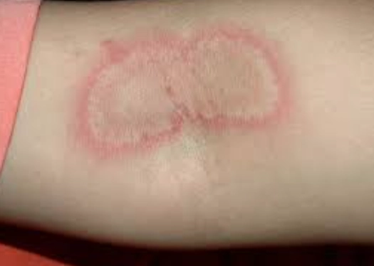 隱翅蟲叮咬處理 隱翅蟲叮咬處理