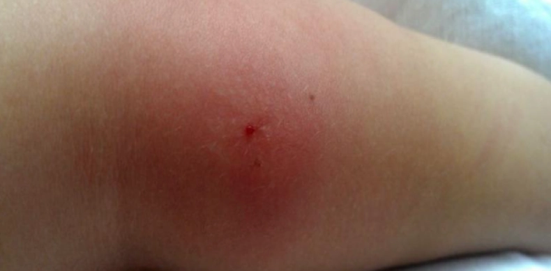 蟲咬止癢方法 蟲咬止癢方法