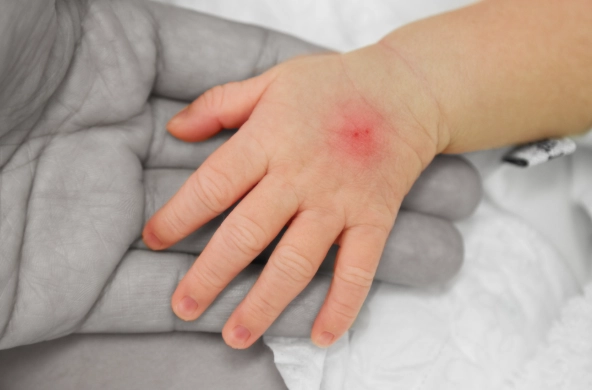 蚊蟲叮咬處理 蚊蟲叮咬處理