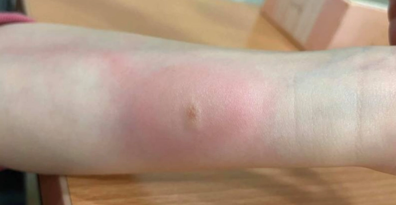 蚊蟲叮咬處理 蚊蟲叮咬處理