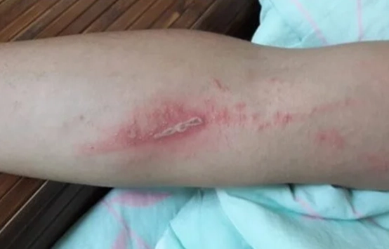 隱翅蟲皮膚炎症狀