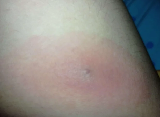 蟲咬止癢方法 蟲咬止癢方法