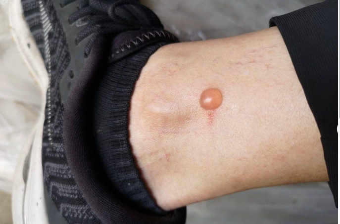 隱翅蟲傷口傳染 隱翅蟲傷口傳染