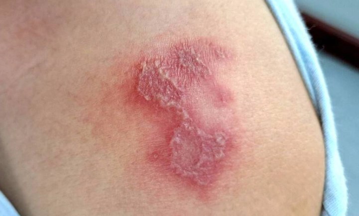 隱翅蟲傷口藥膏