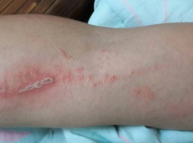 隱翅蟲傷口