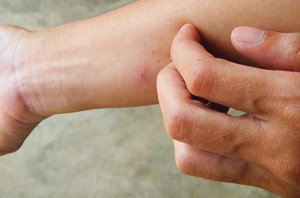 蟲咬止癢方法 蟲咬止癢方法