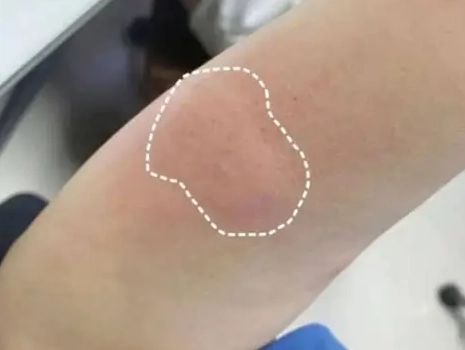 蟲咬止癢方法 蟲咬止癢方法