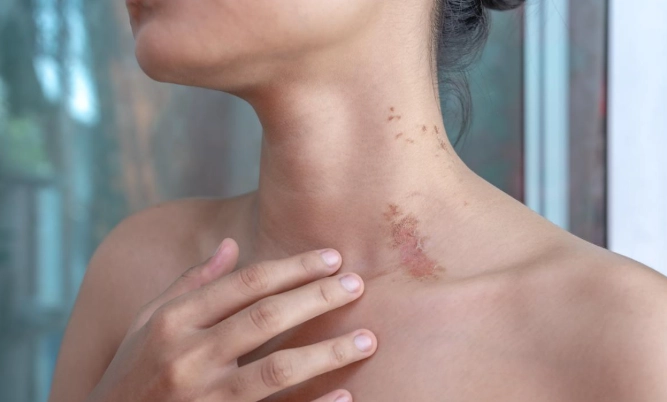 隱翅蟲皮膚炎 隱翅蟲皮膚炎