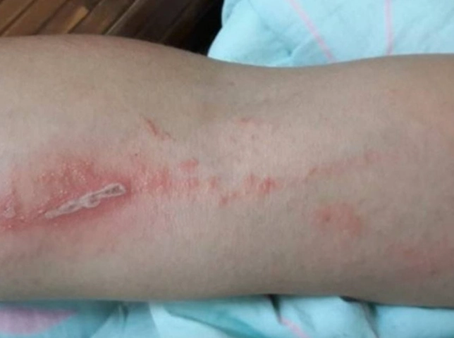 隱翅蟲叮咬處理 隱翅蟲叮咬處理