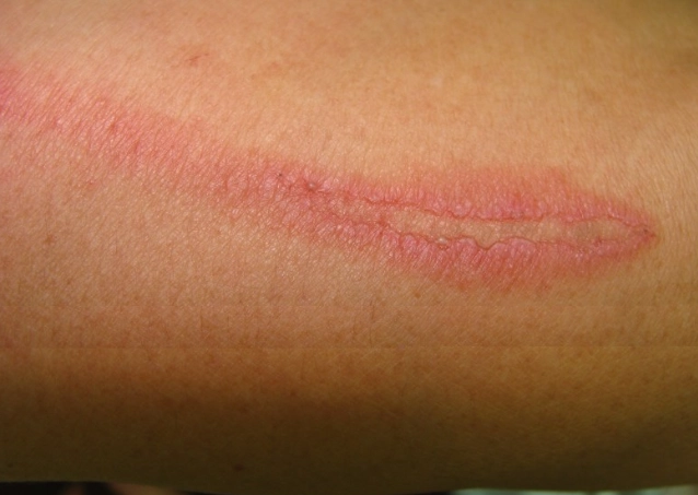 隱翅蟲皮膚炎 隱翅蟲皮膚炎