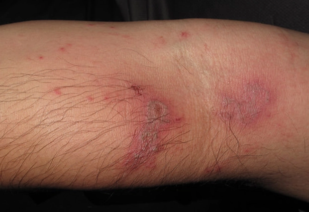 隱翅蟲毒液處理