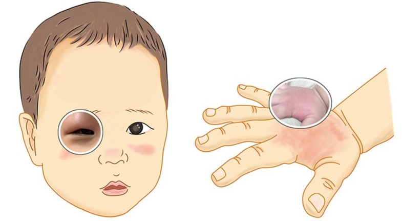 被蚊子咬腫很大硬硬的